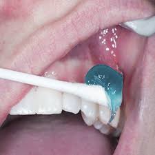 فروش ژل بی حسی دندانپزشکی + قیمت خرید استثنائی